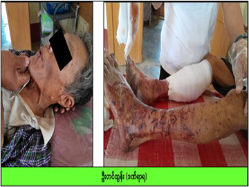 မကွေးတိုင်းဒေသကြီး၊ မင်းလှမြို့နယ်၌ PDF အမည်ခံ အကြမ်းဖက်အဖွဲ့က ထောင်ထားသည့် နင်းမိုင်း တစ်လုံး ပေါက်ကွဲမှုကြောင့် အပြစ်မဲ့ အရပ်သားပြည်သူ တစ်ဦး ထိခိုက်ဒဏ်ရာရရှိ