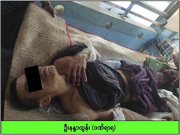 မွန်ပြည်နယ်၊ သံဖြူဇရပ်မြို့နယ်၌ KNU အဖွဲ့မှ အကြမ်းဖက်မှုကို လိုလားသူများနှင့် PDF အမည်ခံ အကြမ်းဖက်သမားများ ပူးပေါင်းအဖွဲ့က ထောင်ထားသည့် မိုင်း တစ်လုံး ပေါက်ကွဲခဲ့မှုကြောင့် အပြစ်မဲ့ အရပ်သားပြည်သူ တစ်ဦး ထိခိုက်ဒဏ်ရာရရှိ