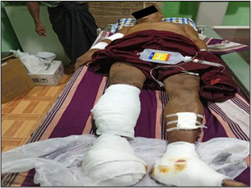 မကွေးတိုင်းဒေသကြီး၊ ပခုက္ကူမြို့နယ်၌ PDF အမည်ခံ အကြမ်းဖက်အဖွဲ့ထောင်ထားသည့် လက်လုပ် နင်းမိုင်း တစ်လုံးပေါက်ကွဲမှုကြောင့် သာသနာ့နွယ်ဝင် သံဃာတော်တစ်ပါး ထိခိုက်ဒဏ်ရာရရှိ