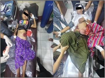 မကွေးတိုင်းဒေသကြီး၊ ပခုက္ကူမြို့နယ်၌ PDF အမည်ခံ အကြမ်းဖက်အဖွဲ့က ကျေးရွာအတွင်းသို့ Drop Bomb များ ပစ်ချတိုက်ခိုက်ခဲ့မှုကြောင့် ကလေးငယ် တစ်ဦး အပါအဝင် အပြစ်မဲ့ အရပ်သားပြည်သူ နှစ်ဦး ထိခိုက်ဒဏ်ရာရရှိ