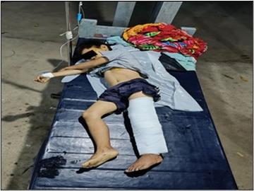 ကချင်ပြည်နယ်၊ ဝိုင်းမော်မြို့နယ်၌ KIA လက်နက်ကိုင်သောင်းကျန်းသူအဖွဲ့နှင့် PDF အမည်ခံ အကြမ်းဖက်သမားများ ပူးပေါင်းအဖွဲ့က ကျေးရွာအတွင်းသို့ လက်နက်ကြီးဖြင့် ပစ်ခတ်တိုက်ခိုက်ခဲ့မှုကြောင့် ကလေးငယ် တစ်ဦး ထိခိုက်ဒဏ်ရာရရှိ