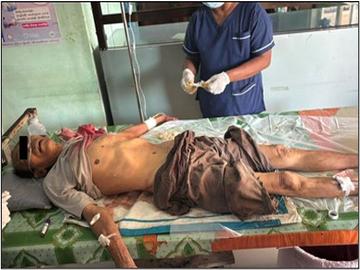 စစ်ကိုင်းတိုင်းဒေသကြီး၊ ရွှေဘိုမြို့နယ်၌ PDF အမည်ခံ အကြမ်းဖက်အဖွဲ့ ထောင်ထားသည့် မိုင်း တစ်လုံး ပေါက်ကွဲခဲ့မှုကြောင့် အပြစ်မဲ့ အရပ်သားပြည်သူ တစ်ဦး ထိခိုက်ဒဏ်ရာရရှိ