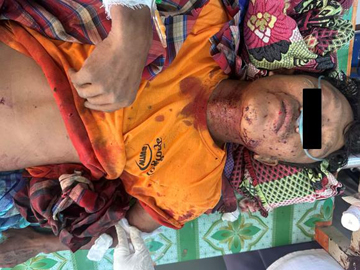စစ်ကိုင်းတိုင်းဒေသကြီး၊ ရွှေဘိုမြို့နယ်၌ PDF အမည်ခံ အကြမ်းဖက်အဖွဲ့ ထောင်ထားသည့် မိုင်း တစ်လုံး ပေါက်ကွဲခဲ့မှုကြောင့် အပြစ်မဲ့ အရပ်သားပြည်သူ တစ်ဦး ထိခိုက်ဒဏ်ရာရရှိ