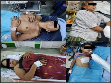 မန္တလေးတိုင်းဒေသကြီး၊ ပုသိမ်ကြီးမြို့နယ်၌ အကြမ်းဖက်အဖွဲ့(စိစစ်ဆဲ)က ကျေးရွာအတွင်းသို့ လက်နက်ကြီးဖြင့် ပစ်ခတ်တိုက်ခိုက်ခဲ့မှုကြောင့် ကလေးငယ် တစ်ဦး အပါအဝင် အပြစ်မဲ့ အရပ်သား ပြည်သူ လေးဦး ထိခိုက်ဒဏ်ရာရရှိ