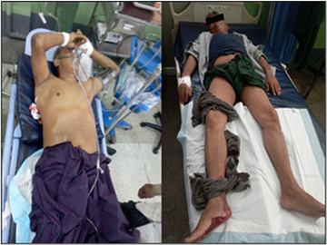 မန္တလေးတိုင်းဒေသကြီး၊ မတ္တရာမြို့နယ်၌ PDF အမည်ခံ အကြမ်းဖက်သမားများ၏ အကြမ်းဖက်မှုလုပ်ရပ်များကြောင့် ကလေးငယ် တစ်ဦး အပါအဝင် အပြစ်မဲ့ အရပ်သားပြည်သူ ခြောက်ဦး ထိခိုက်ဒဏ်ရာရရှိ 